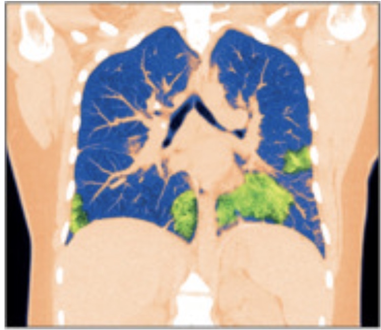 柳叶刀:未成年人吸电子烟易引起肺损伤