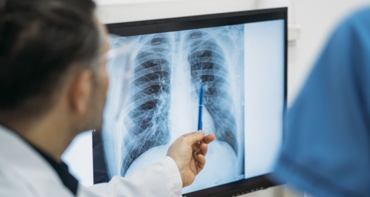 Expertos piden cambio de nombre para la enfermedad pulmonar relacionada con el vapeo.