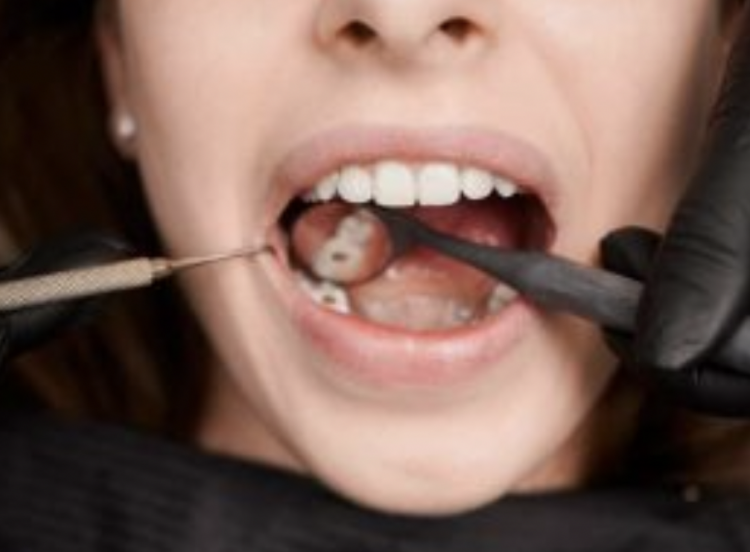 Expertos refutan afirmaciones de que los cigarrillos electrónicos causan daños dentales.