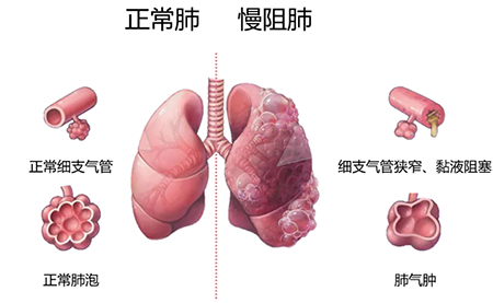 从电子烟到医疗、美容雾化，思摩尔的新道路好走吗？